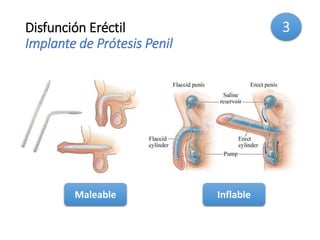 Disfunción Eréctil
Implante de Prótesis Penil
Maleable Inflable
3
 