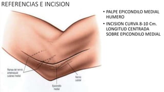 REFERENCIAS E INCISION
• PALPE EPICONDILO MEDIAL
HUMERO
• INCISION CURVA 8-10 Cm.
LONGITUD CENTRADA
SOBRE EPICONDILO MEDIAL
 
