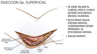 DISECCION Qx. SUPERFICIAL
• SE DEBE PALPAR N.
CUBITAL POR EL SURCO
DETRÁS EPICONDILO
MEDIAL HUMERAL
• SECCIONAR FASCIA
ENCIMA NERVIO,
COMENZANDO DESDE
PROXIMAL AL
EPICONDILO MEDIAL
• AISLAR NERVIO
 