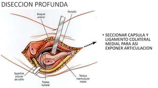 DISECCION PROFUNDA
• SECCIONAR CAPSULA Y
LIGAMENTO COLATERAL
MEDIAL PARA ASI
EXPONER ARTICULACION
 