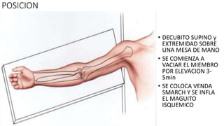 POSICION
• DECUBITO SUPINO y
EXTREMIDAD SOBRE
UNA MESA DE MANO
• SE COMIENZA A
VACIAR EL MIEMBRO
POR ELEVACION 3-
5min
• SE COLOCA VENDA
SMARCH Y SE INFLA
EL MAGUITO
ISQUEMICO
 