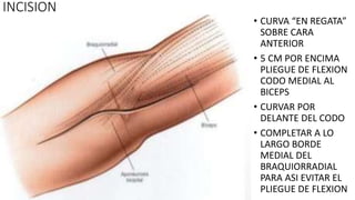 INCISION
• CURVA “EN REGATA”
SOBRE CARA
ANTERIOR
• 5 CM POR ENCIMA
PLIEGUE DE FLEXION
CODO MEDIAL AL
BICEPS
• CURVAR POR
DELANTE DEL CODO
• COMPLETAR A LO
LARGO BORDE
MEDIAL DEL
BRAQUIORRADIAL
PARA ASI EVITAR EL
PLIEGUE DE FLEXION
 