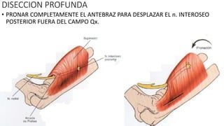 DISECCION PROFUNDA
• PRONAR COMPLETAMENTE EL ANTEBRAZ PARA DESPLAZAR EL n. INTEROSEO
POSTERIOR FUERA DEL CAMPO Qx.
 