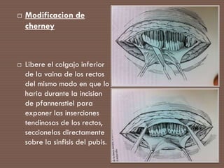 Abordaje quirurgico retroperitoneal | PPTX