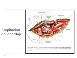 Ampliación
del abordaje
 