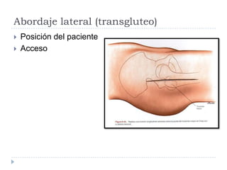 Abordaje lateral (transgluteo)
 Posición del paciente
 Acceso
 