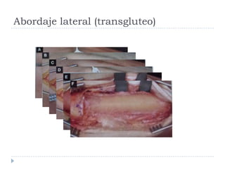 Abordaje lateral (transgluteo)
 