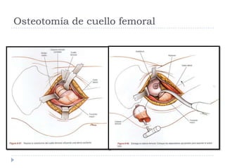 Osteotomía de cuello femoral
 
