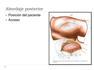 Abordaje posterior
 Posición del paciente
 Acceso
 