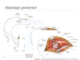 Abordaje posterior
 