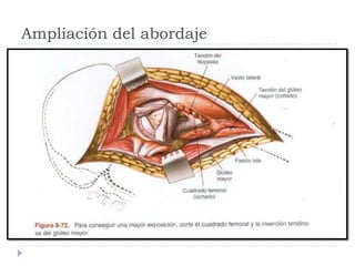 Ampliación del abordaje
 