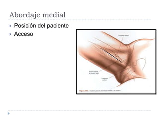 Abordaje medial
 Posición del paciente
 Acceso
 