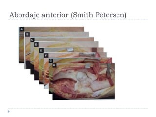 Abordaje anterior (Smith Petersen)
 