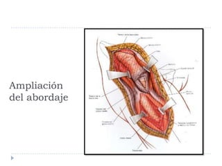 Ampliación
del abordaje
 