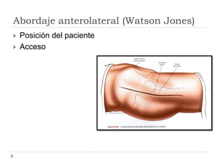 Abordaje anterolateral (Watson Jones)
 Posición del paciente
 Acceso
 