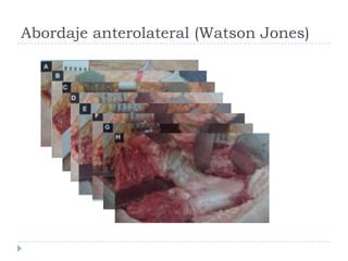 Abordaje anterolateral (Watson Jones)
 