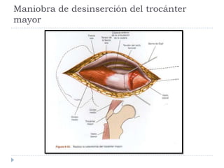Maniobra de desinserción del trocánter
mayor
 