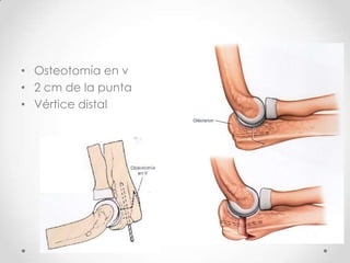 • Osteotomía en v
• 2 cm de la punta
• Vértice distal
 