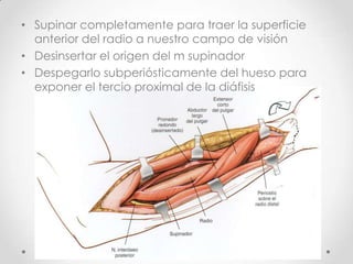 • Supinar completamente para traer la superficie
  anterior del radio a nuestro campo de visión
• Desinsertar el origen del m supinador
• Despegarlo subperiósticamente del hueso para
  exponer el tercio proximal de la diáfisis
 