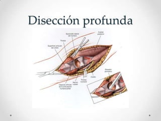 Disección profunda
 