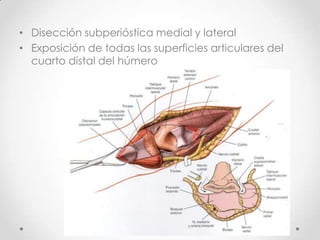 • Disección subperióstica medial y lateral
• Exposición de todas las superficies articulares del
  cuarto distal del húmero
 