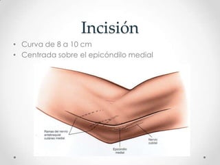Incisión
• Curva de 8 a 10 cm
• Centrada sobre el epicóndilo medial
 