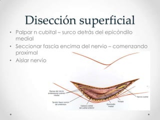Disección superficial
• Palpar n cubital – surco detrás del epicóndilo
  medial
• Seccionar fascia encima del nervio – comenzando
  proximal
• Aislar nervio
 