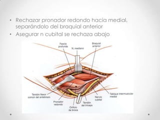 • Rechazar pronador redondo hacia medial,
  separándolo del braquial anterior
• Asegurar n cubital se rechaza abajo
 