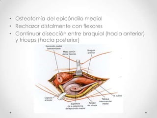• Osteotomía del epicóndilo medial
• Rechazar distalmente con flexores
• Continuar disección entre braquial (hacia anterior)
  y tríceps (hacia posterior)
 