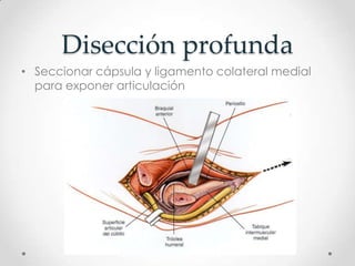 Disección profunda
• Seccionar cápsula y ligamento colateral medial
  para exponer articulación
 
