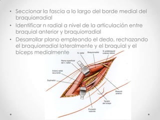 • Seccionar la fascia a lo largo del borde medial del
  braquiorradial
• Identificar n radial a nivel de la articulación entre
  braquial anterior y braquiorradial
• Desarrollar plano empleando el dedo, rechazando
  el braquiorradial lateralmente y el braquial y el
  bíceps medialmente
 
