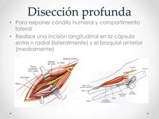 Disección profunda
• Para exponer cóndilo humeral y compartimento
  lateral
• Realizar una incisión longitudinal en la cápsula
  entre n radial (lateralmente) y el braquial anterior
  (medialmente)
 
