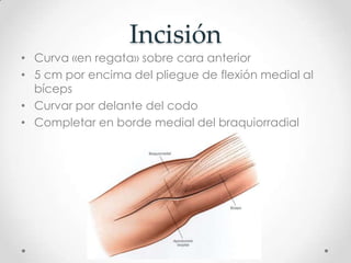Incisión
• Curva «en regata» sobre cara anterior
• 5 cm por encima del pliegue de flexión medial al
  bíceps
• Curvar por delante del codo
• Completar en borde medial del braquiorradial
 