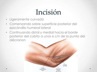 Incisión
• Ligeramente curvada
• Comenzando sobre superficie posterior del
  epicóndilo humeral lateral
• Continuando distal y medial hacia el borde
  posterior del cúbito a unos 6 cm de la punta del
  olécranon
 