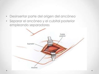 • Desinsertar parte del origen del ancóneo
• Separar el ancóneo y el cubital posterior
  empleando separadores
 