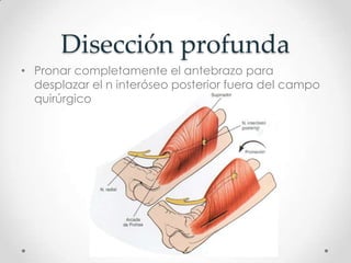 Disección profunda
• Pronar completamente el antebrazo para
  desplazar el n interóseo posterior fuera del campo
  quirúrgico
 