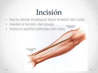 Incisión
• Recta desde el pliegue flexor anterior del codo
• Medial al tendón del bíceps
• Hasta la apófisis estiloides del radio
 