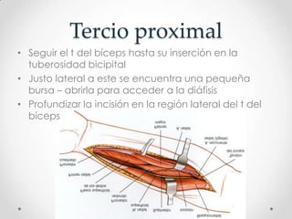 Tercio proximal
• Seguir el t del bíceps hasta su inserción en la
  tuberosidad bicipital
• Justo lateral a este se encuentra una pequeña
  bursa – abrirla para acceder a la diáfisis
• Profundizar la incisión en la región lateral del t del
  bíceps
 