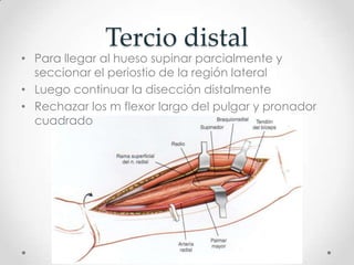 Tercio distal
• Para llegar al hueso supinar parcialmente y
  seccionar el periostio de la región lateral
• Luego continuar la disección distalmente
• Rechazar los m flexor largo del pulgar y pronador
  cuadrado
 