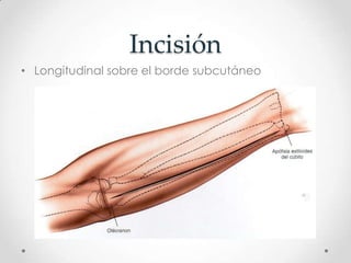 Incisión
• Longitudinal sobre el borde subcutáneo
 