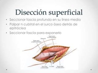 Disección superficial
• Seccionar fascia profunda en su línea media
• Palpar n cubital en el surco óseo detrás de
  epitróclea
• Seccionar fascia para exponerlo
 