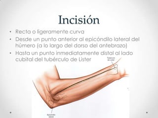 Incisión
• Recta o ligeramente curva
• Desde un punto anterior al epicóndilo lateral del
  húmero (a lo largo del dorso del antebrazo)
• Hasta un punto inmediatamente distal al lado
  cubital del tubérculo de Lister
 