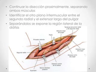 • Continuar la disección proximalmente, separando
  ambos músculos
• Identificar el otro plano intermuscular entre el
  segundo radial y el extensor largo del pulgar
• Separándolos se expone la región lateral de la
  diáfisis
 