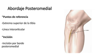 Tibia Linea Abordajes de Tibia en traumatologia y ortopedia .pptx