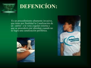 DEFENICÍON:
Es un procedimiento altamente invasivo,
que tiene por finalidad la Canalización de
un catéter a la vena yugular externa y
que se procederá este abordaje cuando no
se logra una canalización periférica.
 