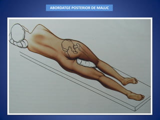 ABORDATGE POSTERIOR DE MALUC
 