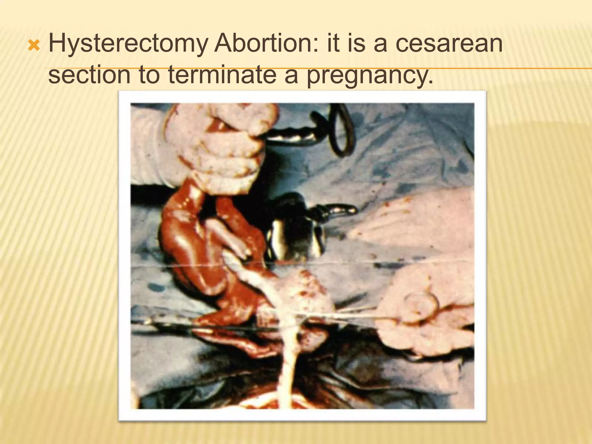    Hysterectomy Abortion: it is a cesarean
    section to terminate a pregnancy.
 