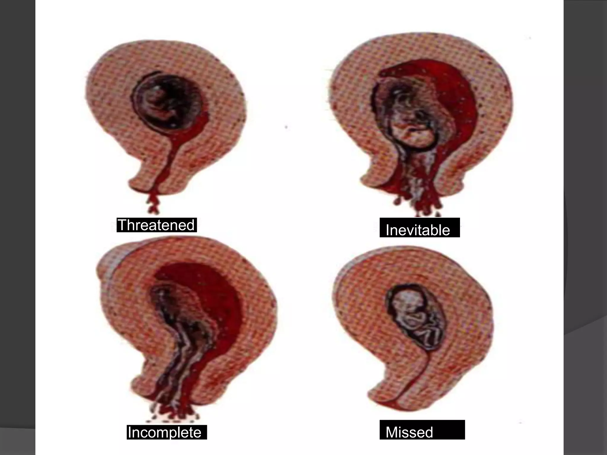 Threatened Abortion Inevitable
Incomplete Missed
 