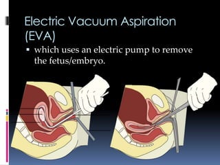 Electric Vacuum Aspiration
(EVA)
 which uses an electric pump to remove
the fetus/embryo.
 