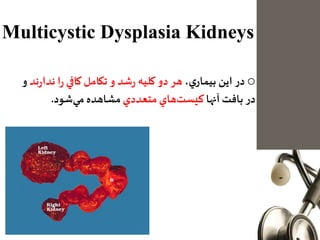 Multicystic Dysplasia Kidneys
o‫در‬‫اين‬،‫ي‬‫بيمار‬‫هر‬‫دو‬‫كليه‬‫شد‬‫ر‬‫و‬‫تكامل‬‫كافي‬‫ا‬‫ر‬‫ن‬‫ند‬‫ر‬‫دا‬‫و‬
‫در‬‫بافت‬‫آنها‬‫هاي‬‫كيست‬‫متعددي‬‫مشاهده‬‫شود‬‫مي‬.
 